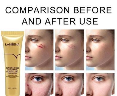 LANBENA TCM SKIN CARE GEL SCAR AND ACNE MARK REMOVAL OINTMENT for sale in Mirpur, Dhaka